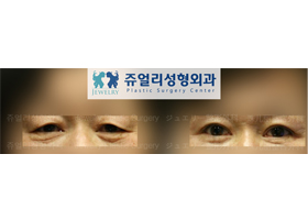 Upper+ Lower Blepharoplasty