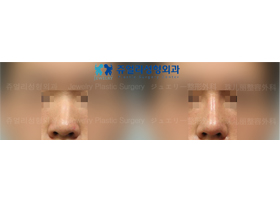 Nose Surgery
