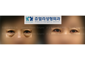 Upper/Lower Blepharoplasty