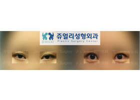 Ptosis + Eye's Tail + Loveband