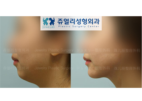 Double Chin Liposuction, Chin Implant