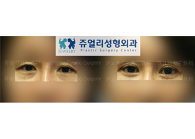 Upper/Lower Blepharoplasty