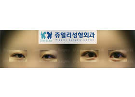 Ptosis + Loveband