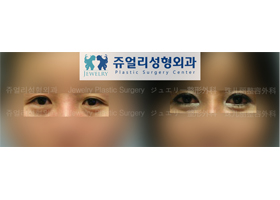 Upper/Lower Blepharoplasty