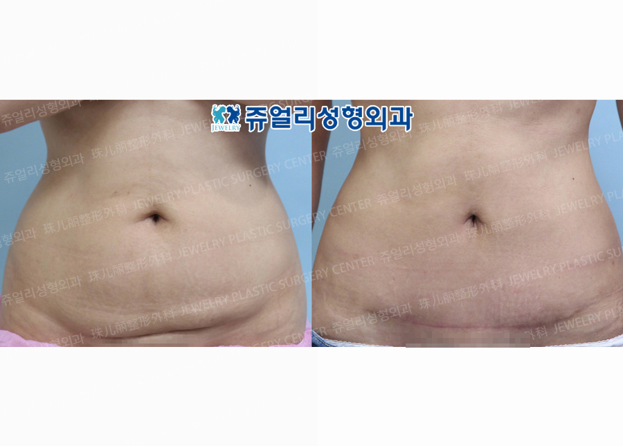 Abdominal Wall Surgery + Liposuction