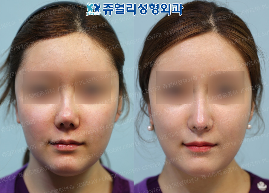 Nose Reoperation (Collapsed Nose) - Costal Cartilage/Short Nose