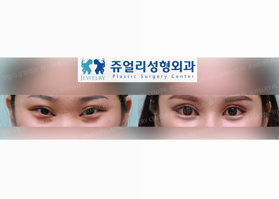 Ptosis (Eyes Enlargement)+Lateral Canthoplasty+Eyes Tail (Lower Lateral Canthoplasty)