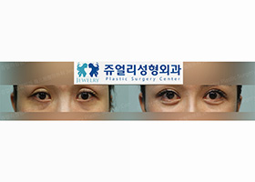 Double Eyelids Reoperation