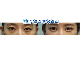 Double Eyelids Reoperation + Dark Circle Removal (Fat-Repositioning) + Loveband