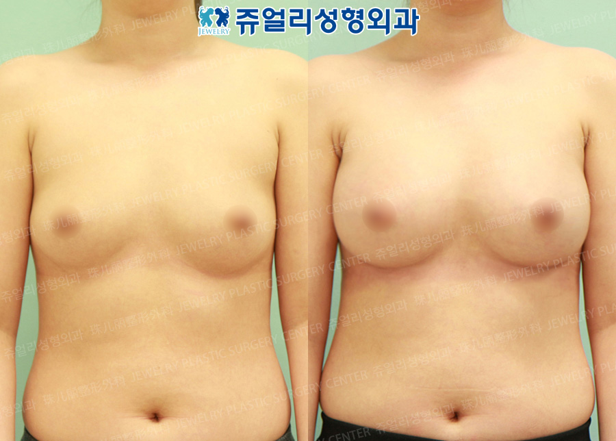 Breast Augmentation