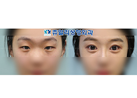 Double Eyelids (Incision) + Epicanthoplasty+Lateral Canthoplasty+Fat-Repositioning Transconjunctival Blepharoplasty+Loveband