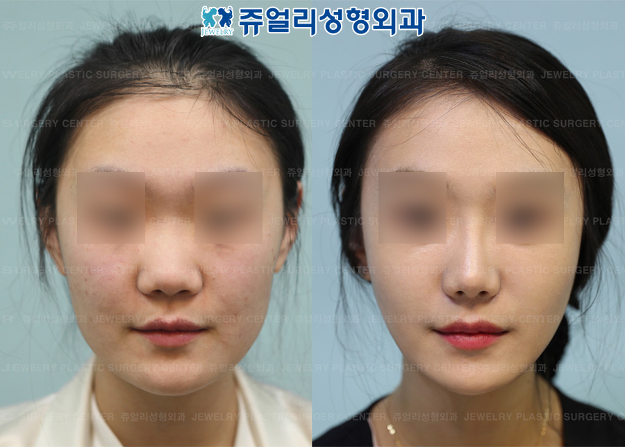 Nose Surgery - Low Nose Surgery