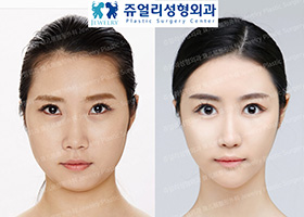 Face Surgery