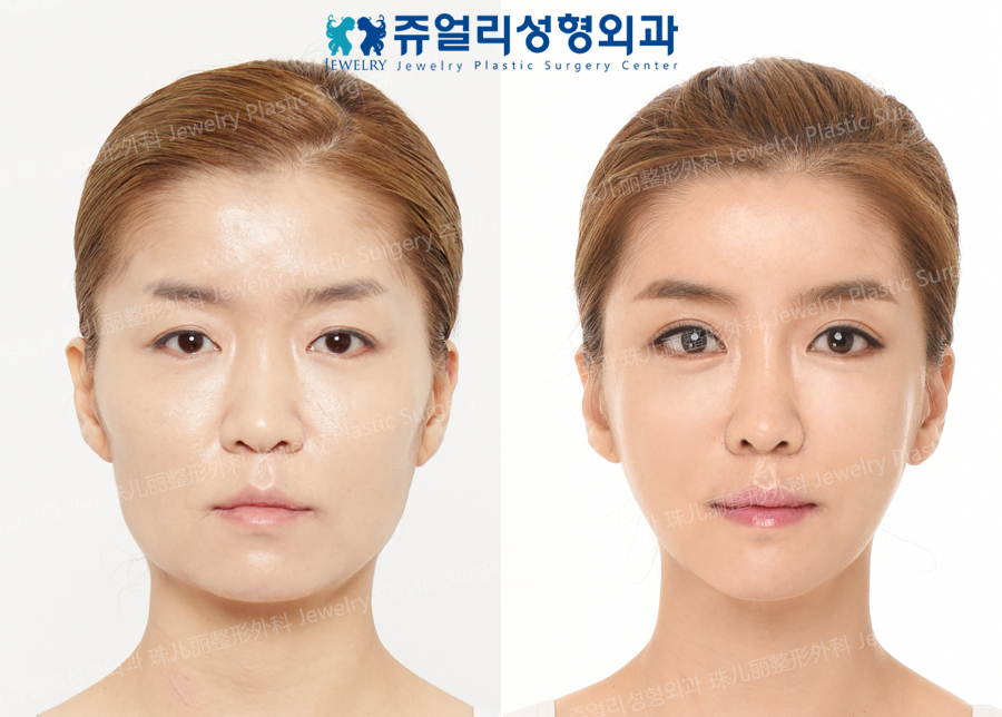 Signature Eyes Surgery+Nose Surgery+3D Cube Fat Grafting+Face Contouring+Double Chin Liposuction+Polymastia Removal, Breast Surgery (Teardrop Augmentation)