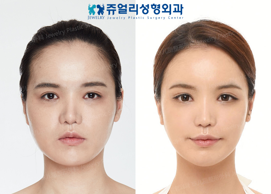 Face Surgery