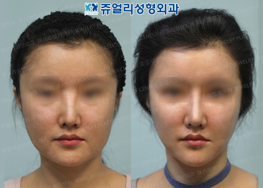 Nose Reoperation+Fat Grafting+Cheek Liposuction+Jaw Line Lifting