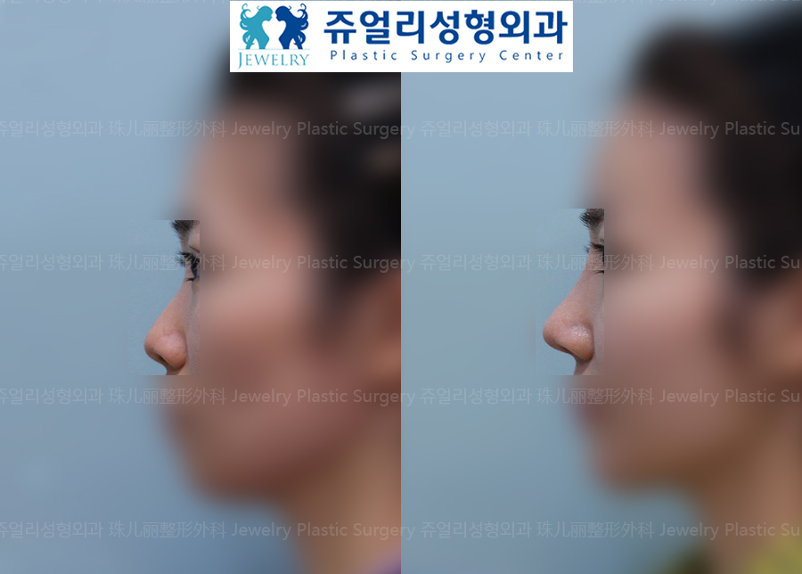 Nose Surgery