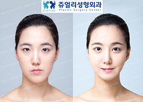 Double Eyelids (Incision), Nose Surgery, Fat Grafting, Facial Contouring Surgery