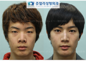 Double Eyelids (Double Buried Method) + Nose Surgery (Nose Line, Nose Tip Reduction) + Flat Chin Implant
