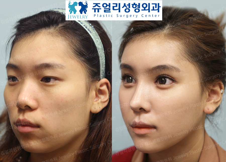 Eyes Surgery+Nose Surgery+Face Fat Grafting+Glabella Botox+3DCT Cheekbone Reduction + V-Line Square Jaws Reduction