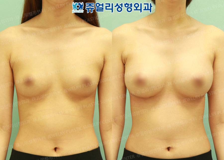 Breast Augmentation