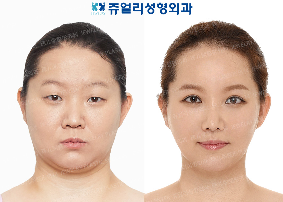 Eyes Surgery+Nose Surgery+3D Cube Fat Grafting+ Chin Botox & Contour Injection + Double Chin/Cheek Liposuction