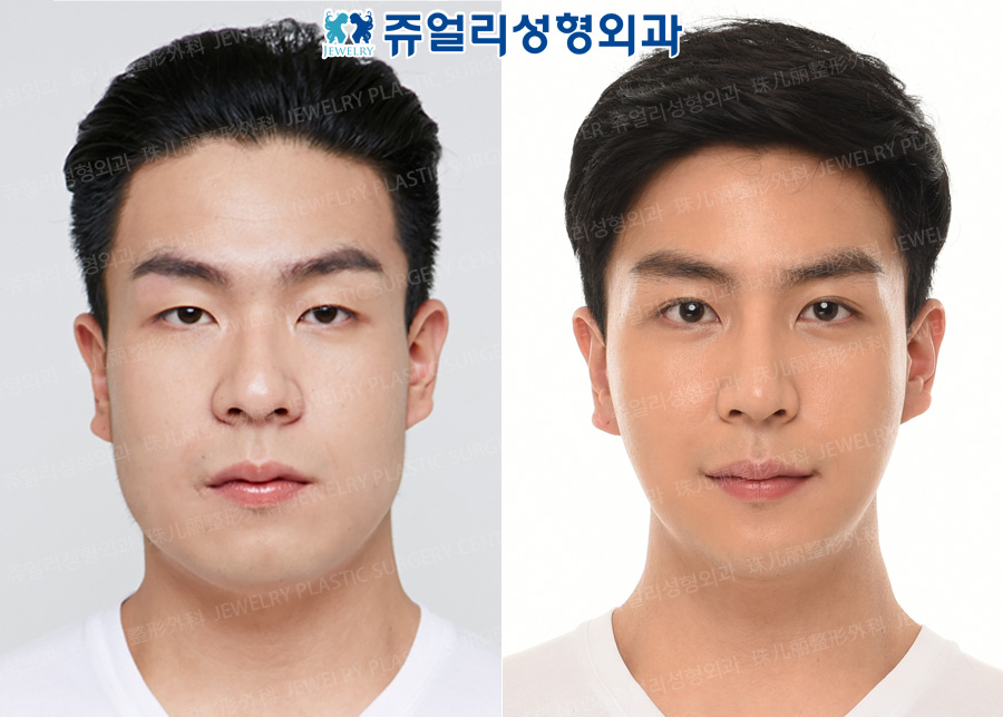 Double Eyelids (Incision), Ptosis Correction, Nose Surgery, Square Jaw Reduction, T-osteotomy, Chin Botox