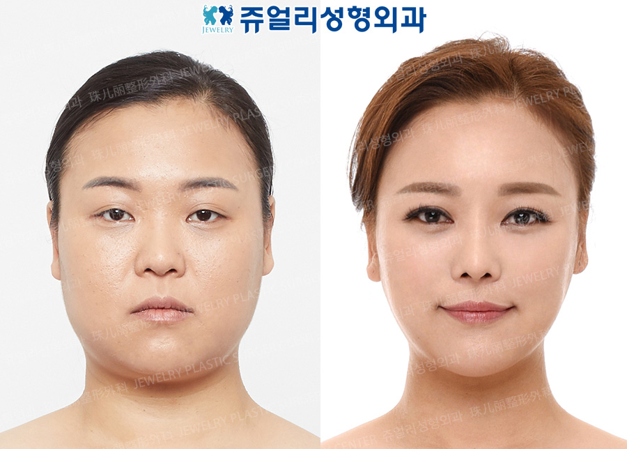Eyes Surgery + Nose Surgery + 3D Cube Fat Grafting + Chin Botox & Contour Injection + Double Chin/Cheek Liposuction