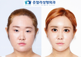 Eyes Surgery+Nose Surgery+Fat Grafting+Cheekbone Reduction+Square Jaws Reduction+Double Chin Liposuction+Chin Botox