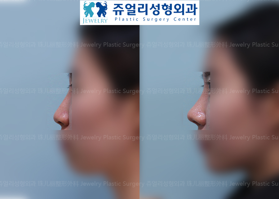 Nose Surgery