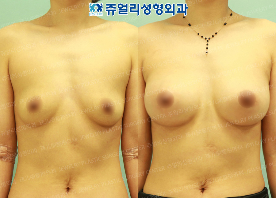 Breast Augmentation