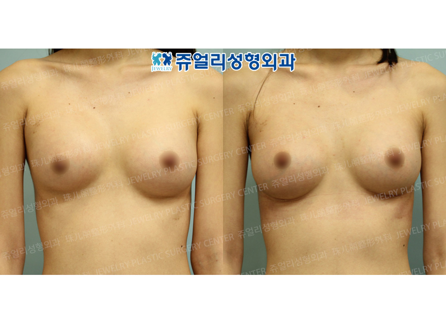 Breast Augmentation Reoperation - Endoscope