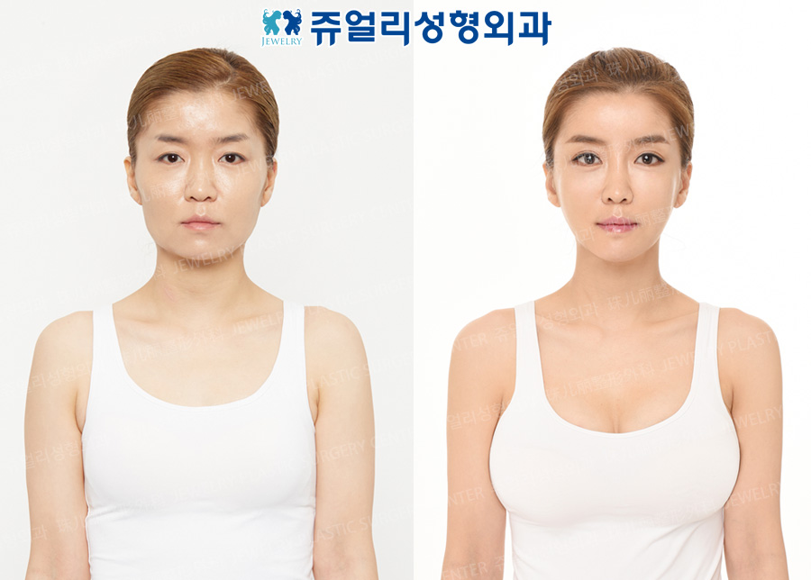 Teardrop Breast Surgery + Polymastia Removal Surgery