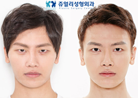 Eyes Non-Incision+Epicanthoplasty+Nose Surgery+Cheekbone Reduction+Chin Implant