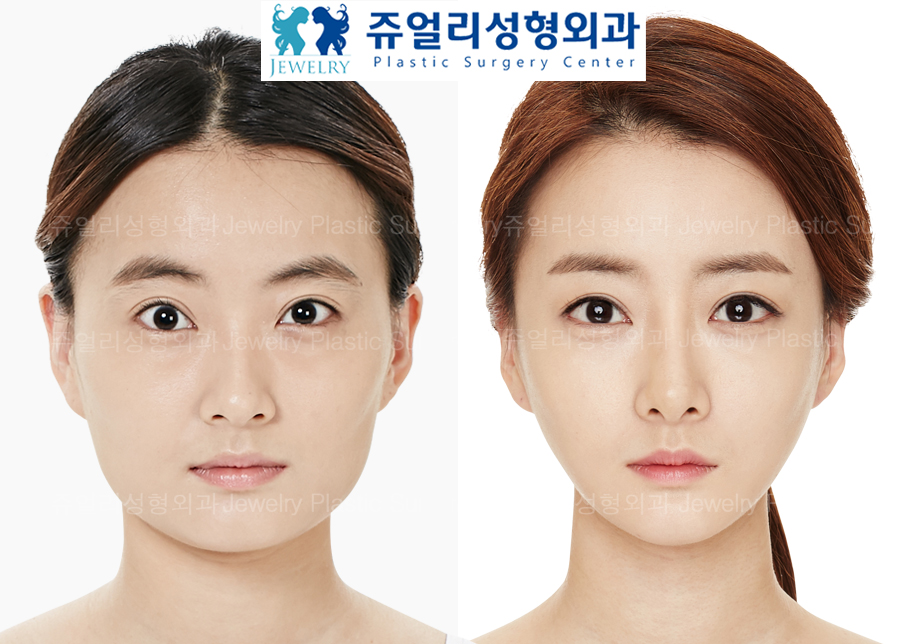 Eyes Surgery + Nose Surgery + Fat Grafting+Facial Contouring Surgery