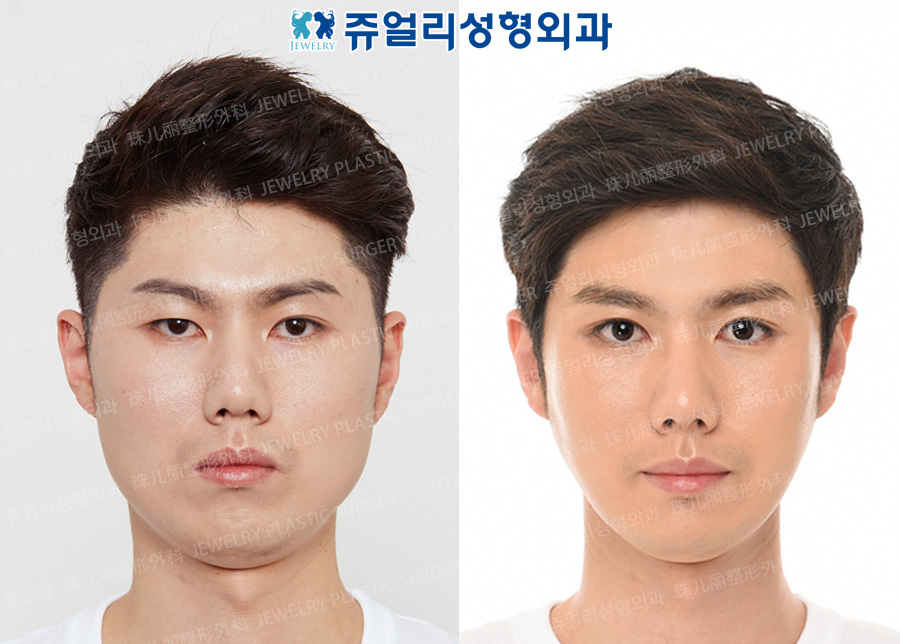 Eyes Reoperation+Chin Implant+Square Jaws Reduction+Chin Botox+Cheekbone Reduction
