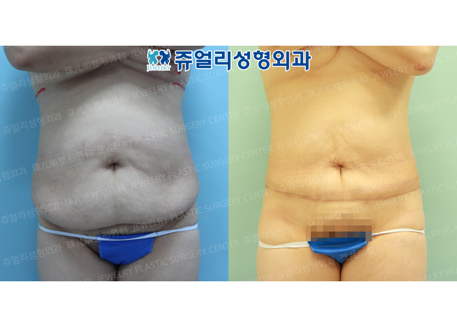 Abdominal Wall Surgery + Liposuction