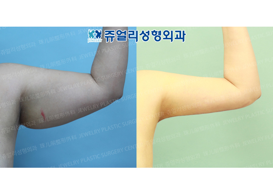 Arm Liposuction (+Face Excision)