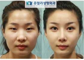 Eyes Surgery + Nose Surgery + Face Fat Grafting + 3DCT Cheekbone Reduction + V-Line Square Jaws Reduction + Flat Chin Implant