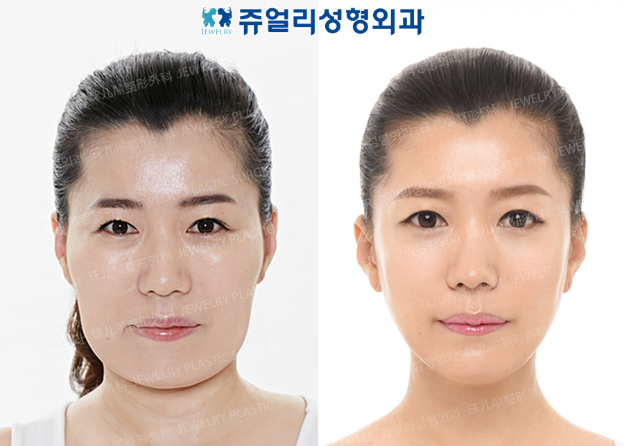 Cheekbone Reduction+Square Jaws Reduction+T-osteotomy