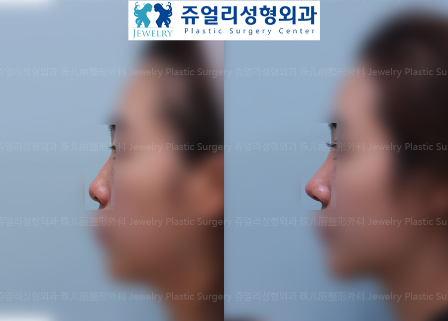 Nose Surgery