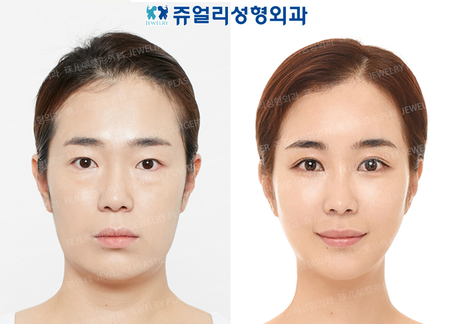 Eyes Reoperation+Upper Epicanthoplasty+Lower Lateral Canthoplasty+Fat-Repositioning Transconjunctival Blepharoplasty+Hump Nose Surgery+Fat Grafting+Front Chin Implant+Cheek,Chin Liposuction