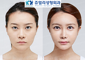 Facial Contouring Surgery, Eyes Surgery, Nose Surgery, Fat Grafting