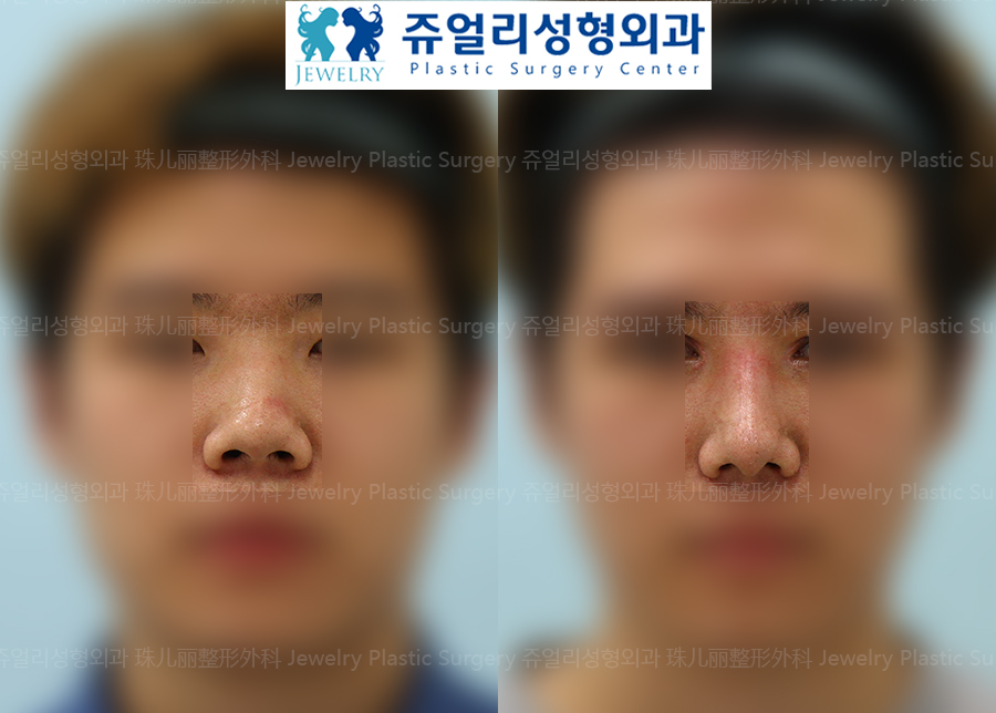 (Men) Nose Surgery - Wide Nose