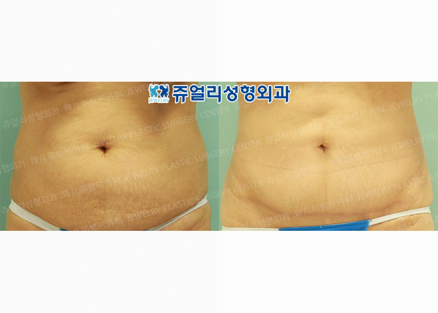 Abdominal Wall Surgery + Liposuction