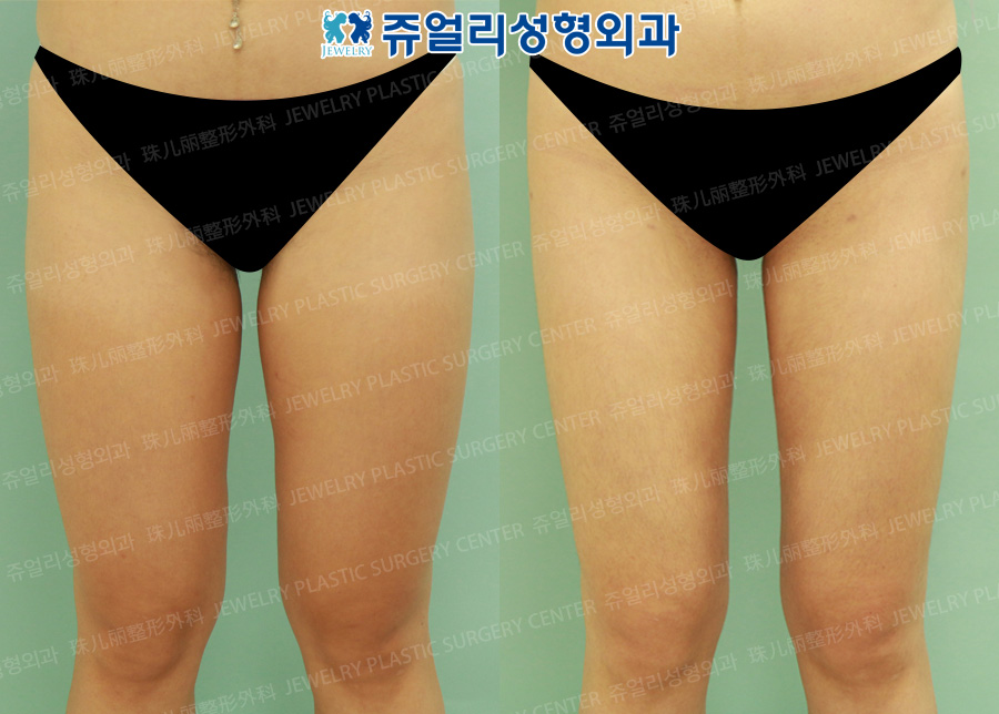 Thigh Liposuction