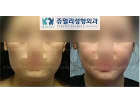 Cheekbone Reduction + Square Jaws Reduction