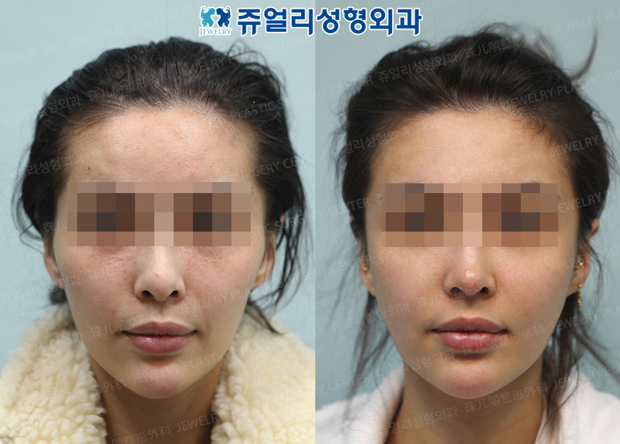 Cheekbone Reduction