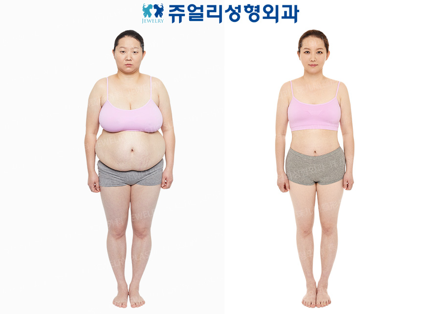 Breast Size Reduction/ Breast Lifting + Abdomen Surgery + Whole Body Corset Liposuction