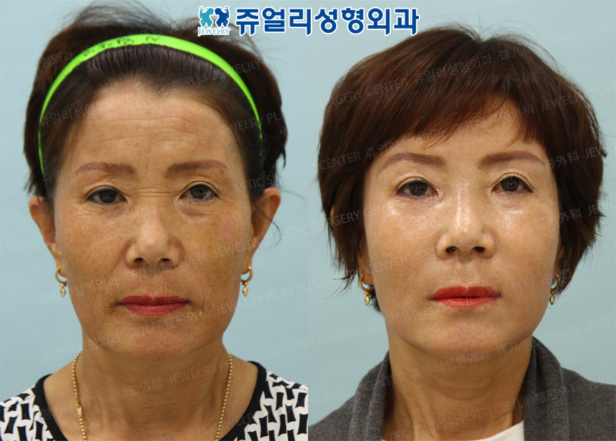 Fat Grafting, Fat-Repositioning Transconjunctival Blepharoplasty, Botox